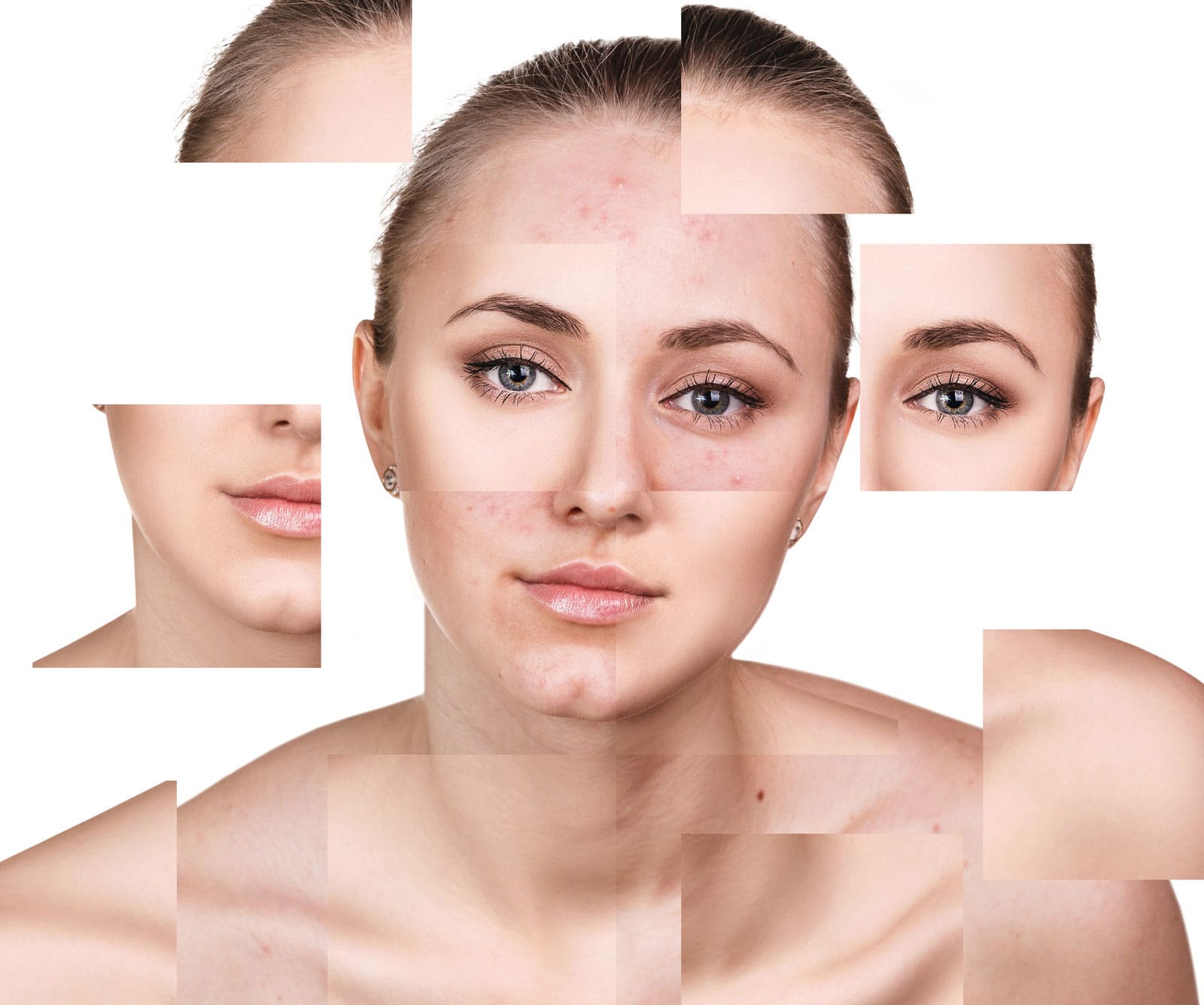 acne examples